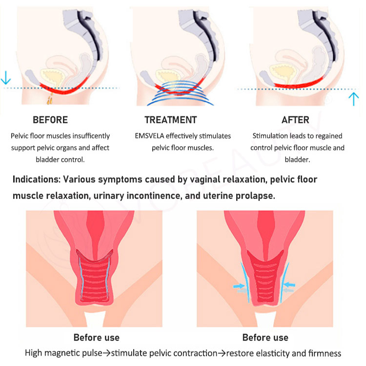 ems pelvic floor